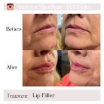 Dermal Filler