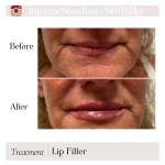 Dermal Filler