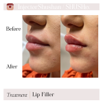 Dermal Filler