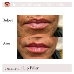 Dermal Filler