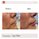 Dermal Filler