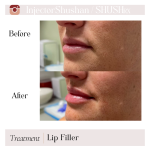 Dermal Filler