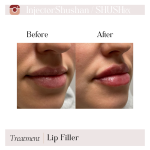 Dermal Filler