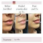 Dermal Filler