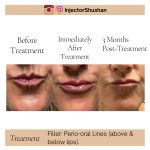 Dermal Filler