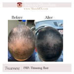 Platelet Rich Plasma (PRP)